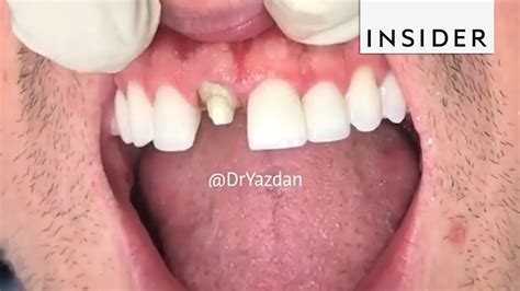 How Dentists Create Tooth Veneers And Crowns - YouTube