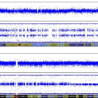 Examples of SNP array data from case 56. Top panels show log2 ratios ...