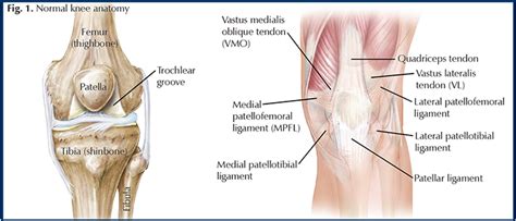 Traumatic Patellar Dislocation - Hughston Clinic