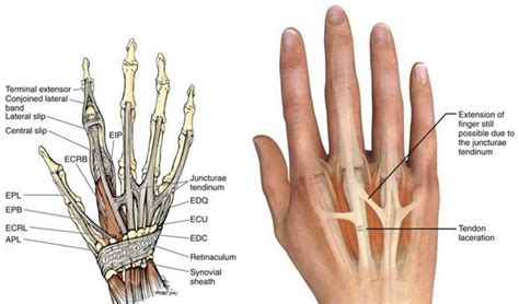 Extensor tendon injury hand therapy | Phoenix Rehab Singapore