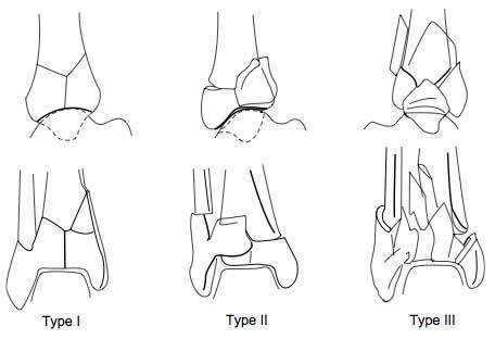 Posterior Lip Of Tibial Plafond | Sitelip.org