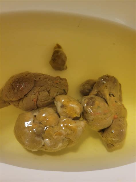 White coating on my daughters poop : r/Gastroenterology