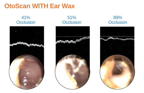 Earwax has met its match with the OtoSight Middle Ear Scope - PhotoniCare