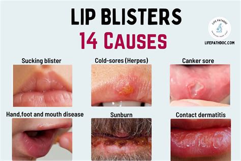 Blister on Lip: Cold Sores and 13 Other Causes (with Pictures)