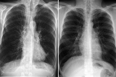 COPD Lungs vs. Normal Lungs on Medical Scans