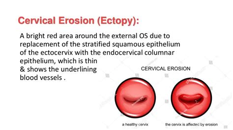 Benign Cervical Lesions