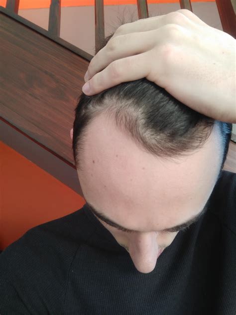 Is my hairline receding? : r/bald