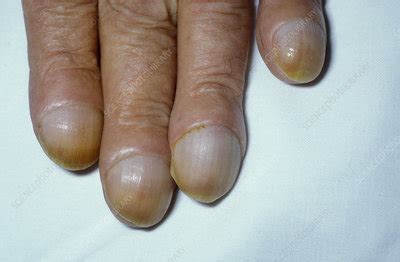 Clubbed fingers - Stock Image - M130/0696 - Science Photo Library