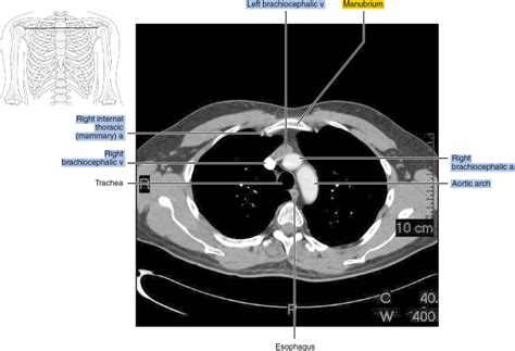 CT of the thorax | Radiology Key