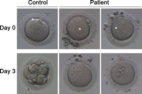 The morphology of a control zygote and the affected individual’s ...