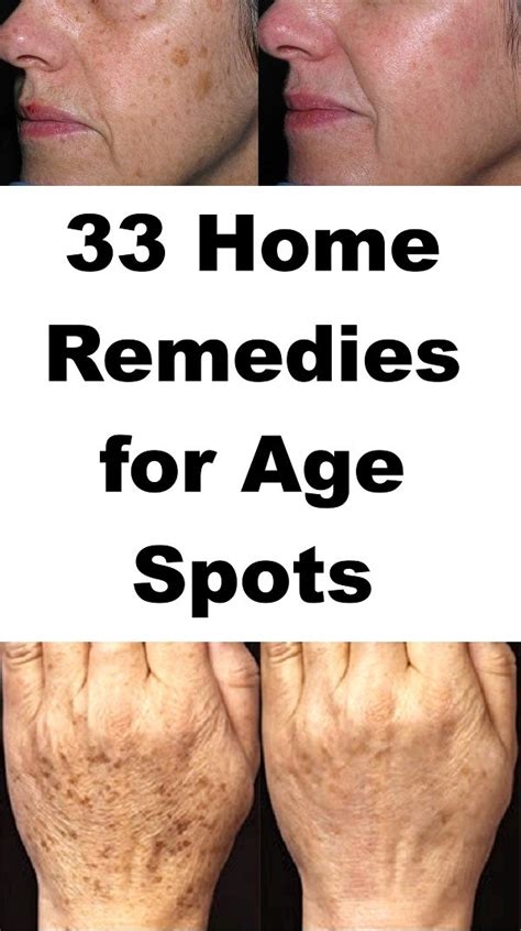 22 Home Remedies To Remove Age Spots on your face, hands & legs