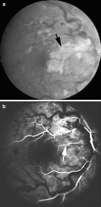 Cilioretinal Artery Occlusion | Ento Key