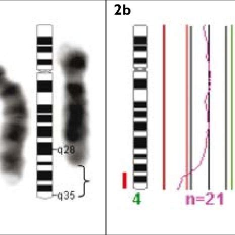 (PDF) Interstitial deletion of the distal long arm of chromosome 4, del ...