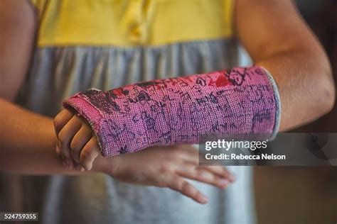 Broken Bone Cast Photos and Premium High Res Pictures - Getty Images