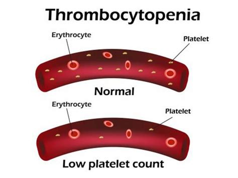 What Is Thrombocytopenia