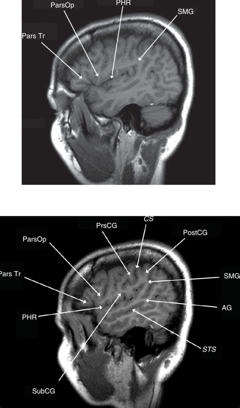 Postcentral Gyrus Mri