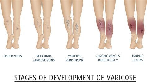 Venous Insufficiency Physical Exam Findings