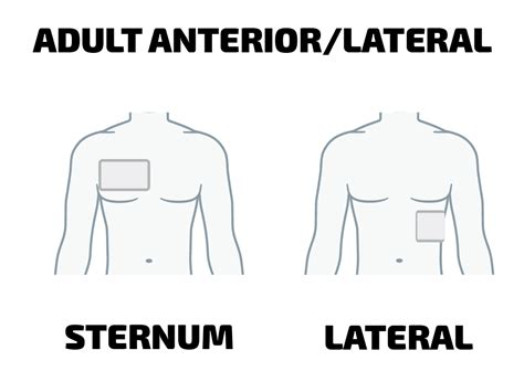 AED Pad Placement FAQ | Heartsmart