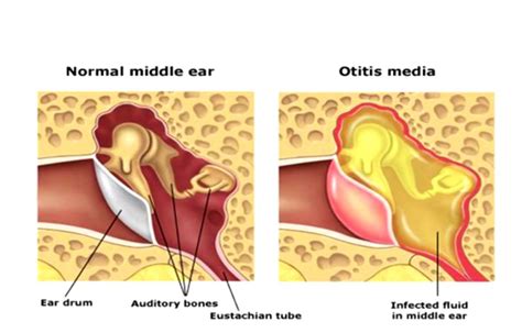 Ear Infection | Causes, Symptoms and Treatment