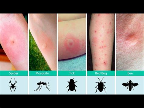 Bed Bug Bites Vs Flea Bites How To Tell The Difference | Images and ...