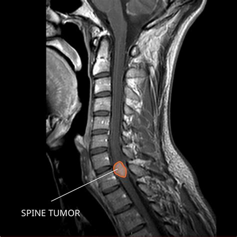 Ependymoma - National Cancer Institute