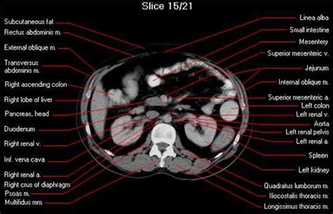 axial CT whole abdomen scan | Ct scan, Radiology imaging, Radiology