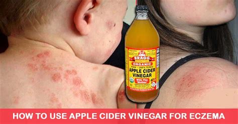 How To Use Apple Cider Vinegar To Fight Eczema Naturally