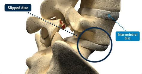 Slipped Disc Symptoms, Causes, and Treatment - Spinal Backrack