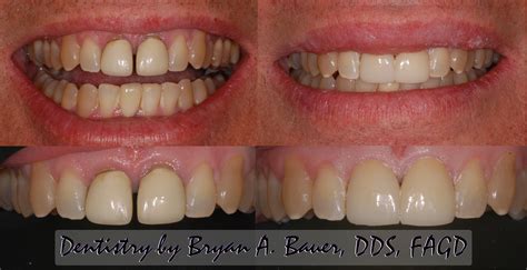 New porcelain crowns - Bauer Smiles