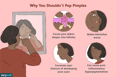 Is Popping Pimples Bad for Your Skin?