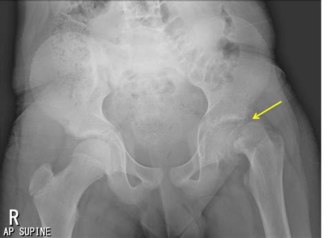 Slipped upper femoral epiphysis – Radiology Cases