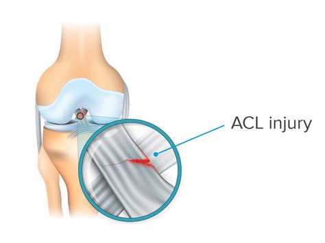 Acl sprain - acetogold