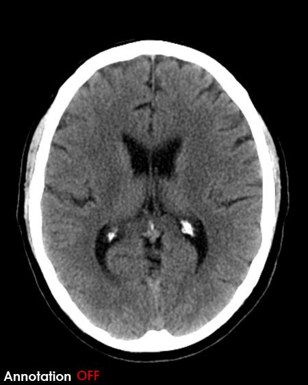 Brain Ventricles Ct Scan