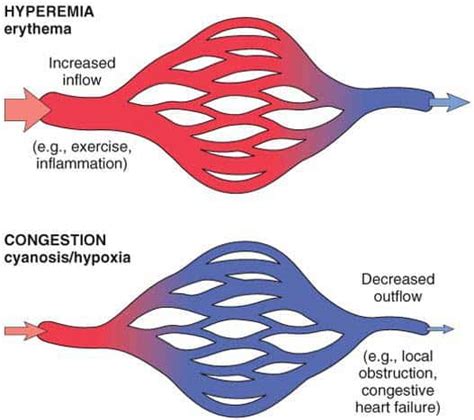 Hyperemia & Congestion - New