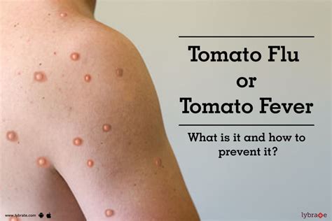 Tomato Flu: Symptoms, Causes, Treatment and Cost