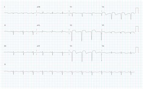 12 Lead ECG Practice Quiz v1 - SkillStat