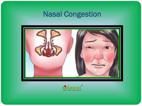 PPT - Nasal Congestion: Causes, Symptoms, Diagnosis and Treatment ...