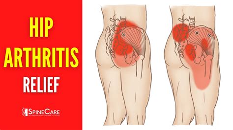 How to Relieve Hip Arthritis Pain in 30 SECONDS - YouTube