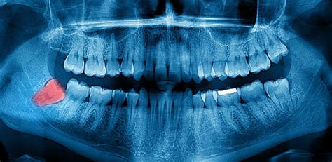 Xray Of Teeth