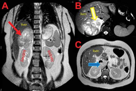 CT scan reveals adrenal mass