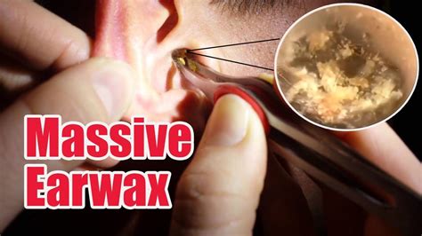 MASSIVE Earwax removal Part 1 - It looks like an insect! - YouTube