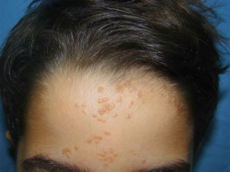 Photos of Warts on Face ~ How To Remove Moles, Warts, Skin Tags Safely