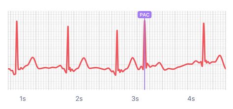 What Premature Atrial Contraction (PAC) Looks Like on Your Watch ECG | Qaly