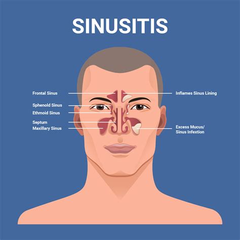 Sinusitis Vector Illustration 170632 Vector Art at Vecteezy