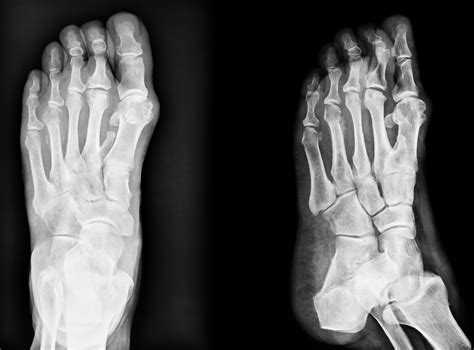 Blog: Bunions, Hammer Toes & Heel Spurs Relief - Northwest Surgery Center