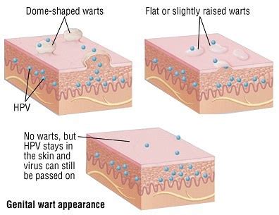 how to identify different types of warts