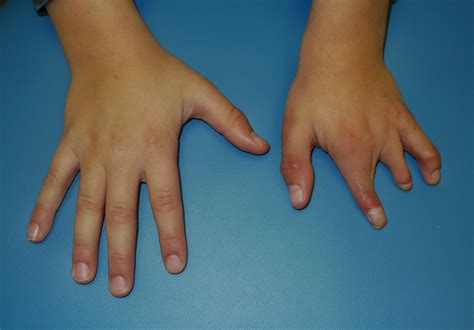 | Congenital Hand and Arm Differences