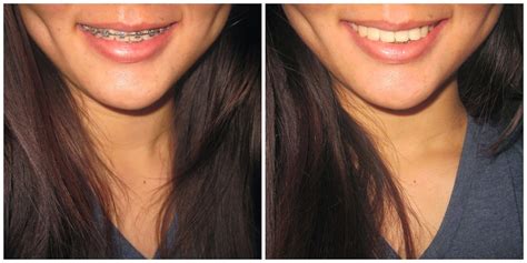 braces before and after | Braces before and after, Braces, After braces