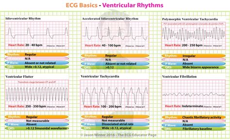 Printable Ekg Rhythms - Printable World Holiday