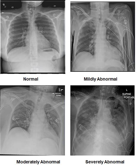 Cureus | COVID-19 vs. Influenza: A Chest X-ray Comparison